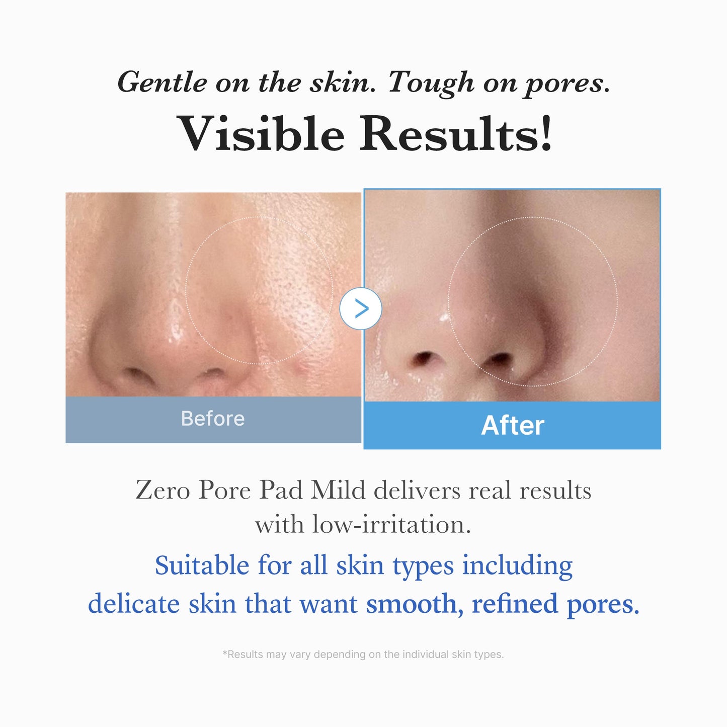 zero-pore-madecassoside-pads-mild-c5 04_6357f9f9-483b-4891-82c6-a58d336e62c8.jpg